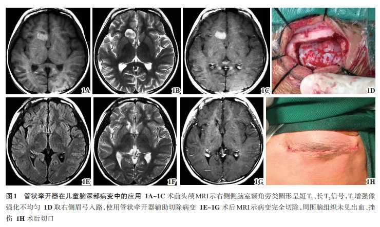 【萊沃醫療：文獻解讀】一次性使用腦部牽開導引導管在兒童腦深部病變的應用研究