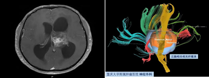 【萊沃醫療：病例分享】重慶大學附屬腫瘤醫院神經外科手術集錦腦部牽開導引導管下切除腦室丘腦膠質瘤